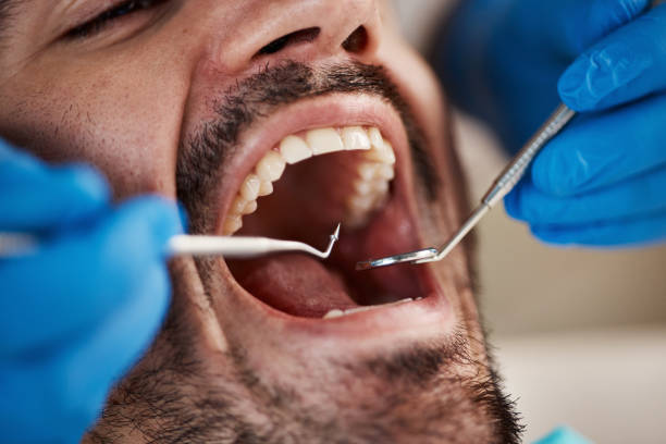 Best Emergency Wisdom Teeth Removal in Saxonburg, PA